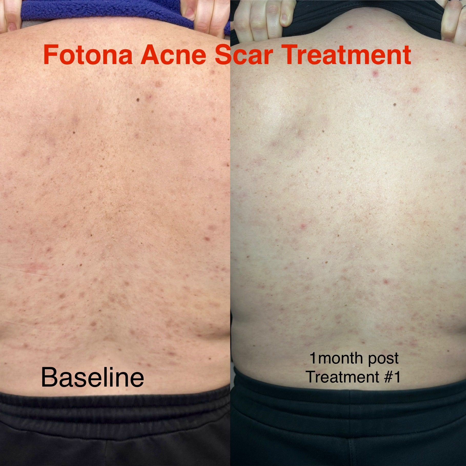 Before and after acne scar treatment
