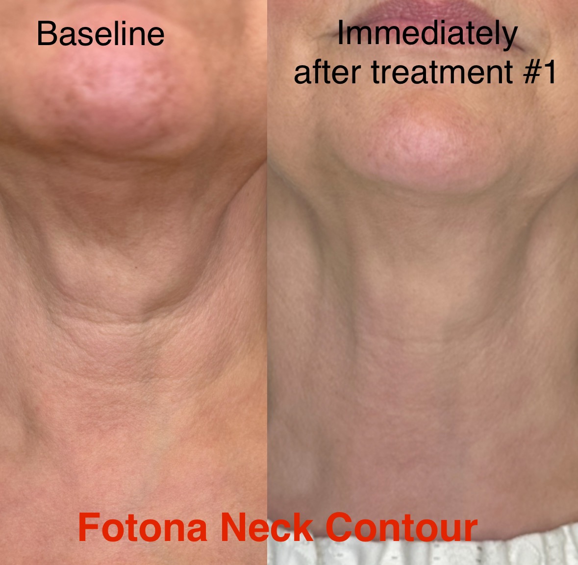 Before and After Neck Contour Treatment